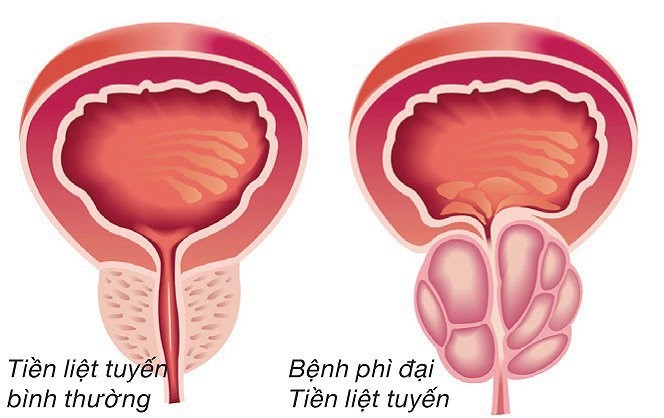 KHI NÀO NÊN PHẪU THUẬT U PHÌ ĐẠI TUYẾN TIỀN LIỆT